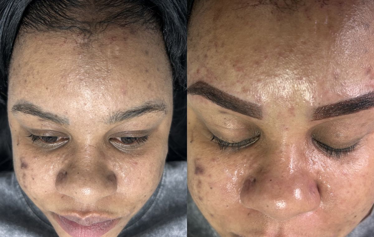 Before and after microshading: the same client before treatment on the left and after on the right